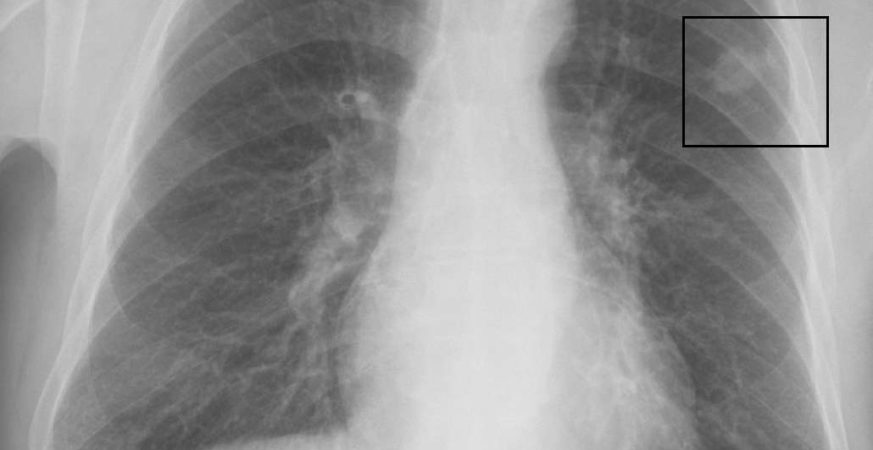 Allergies May Lower Lung Cancer Risk, Study Finds