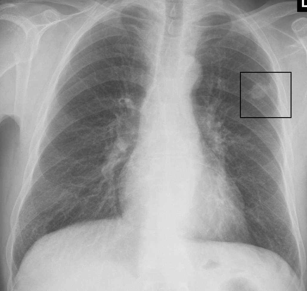 Allergies May Lower Lung Cancer Risk, Study Finds