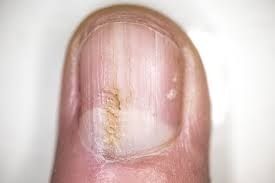 Dark Nail Lines May Signal Hidden Heart Infection