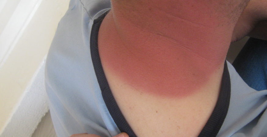 Surrey Residents Warned: Treat Sunburn Seriously, Says Expert