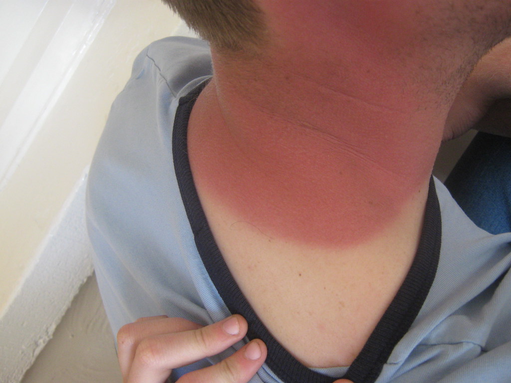 Surrey Residents Warned: Treat Sunburn Seriously, Says Expert